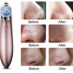 6-in-1 Handheld Vacuum Blackhead Remover and Pore Cleansing Tool