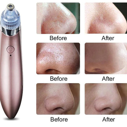 6-in-1 Handheld Vacuum Blackhead Remover and Pore Cleansing Tool